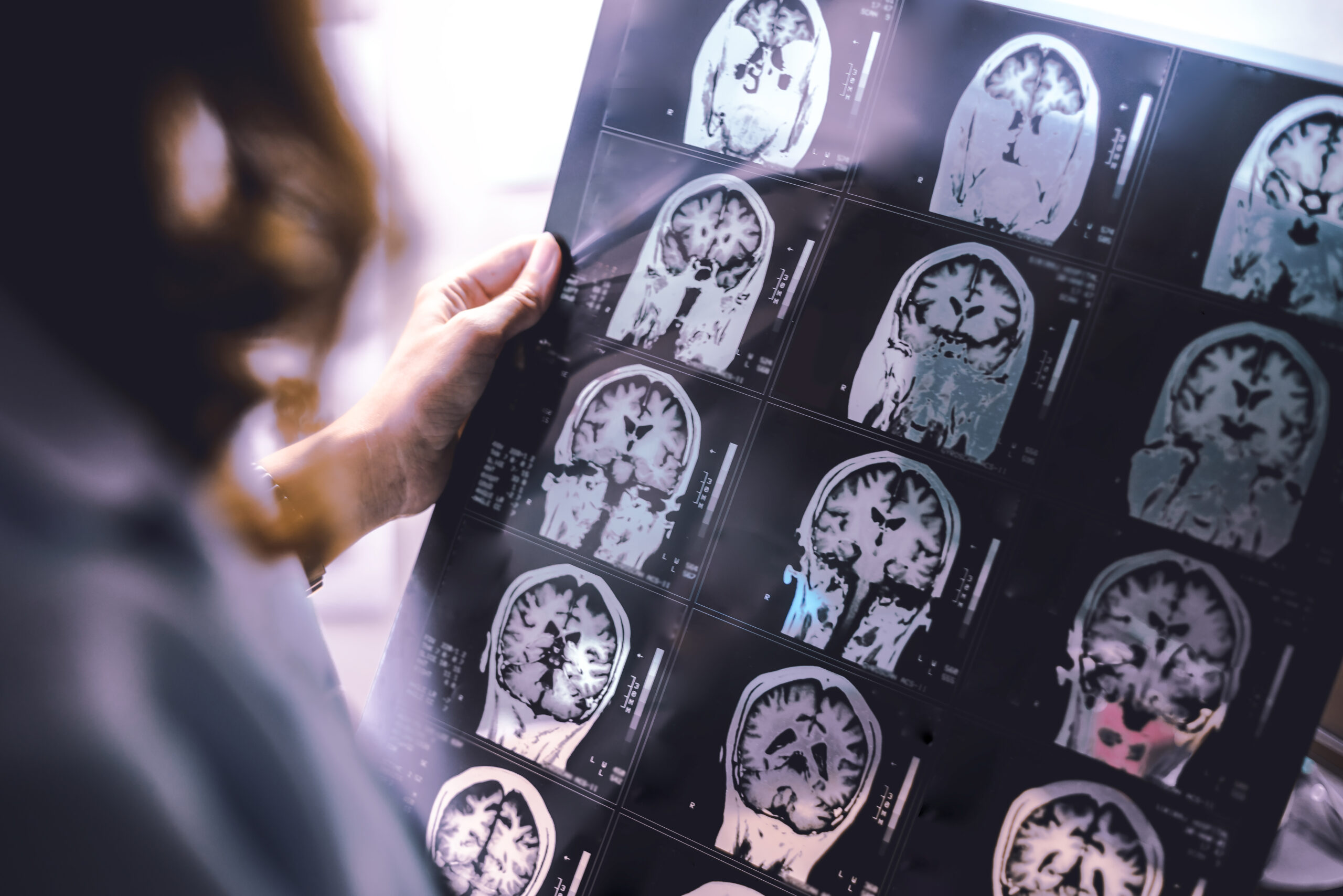 gabapentin side effects, dementia